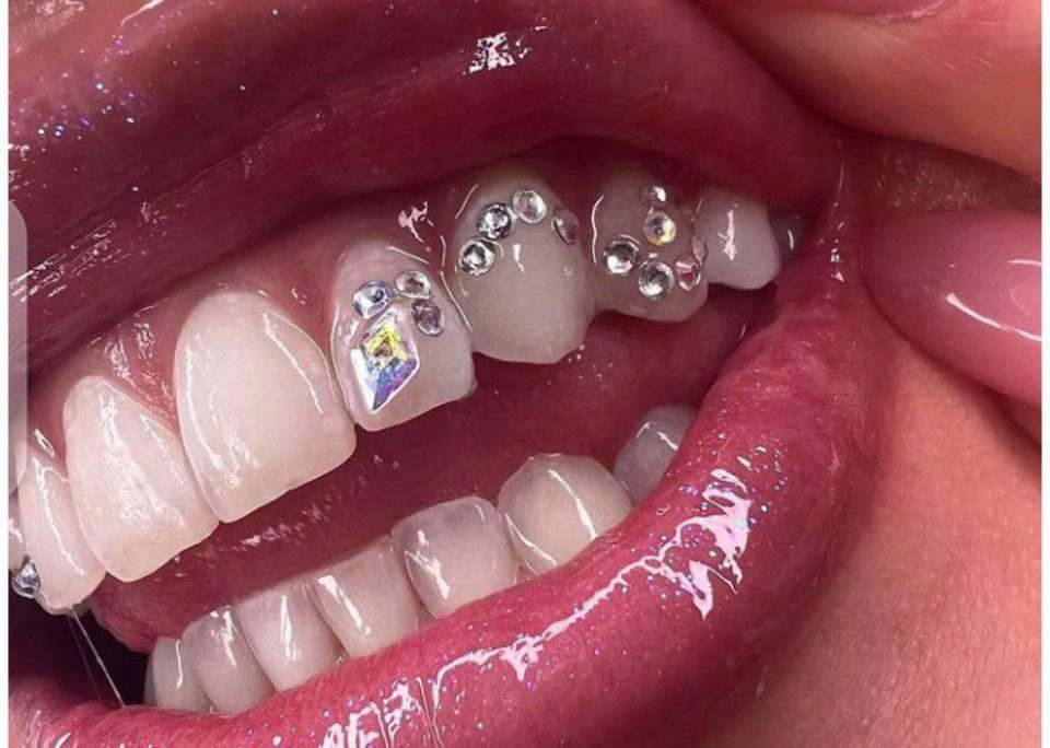 Tooth Jewelry - Tooth Gems in Kampala Uganda - Dental Clinic in Kampala