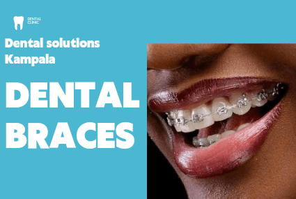 Teeth braces on kampala