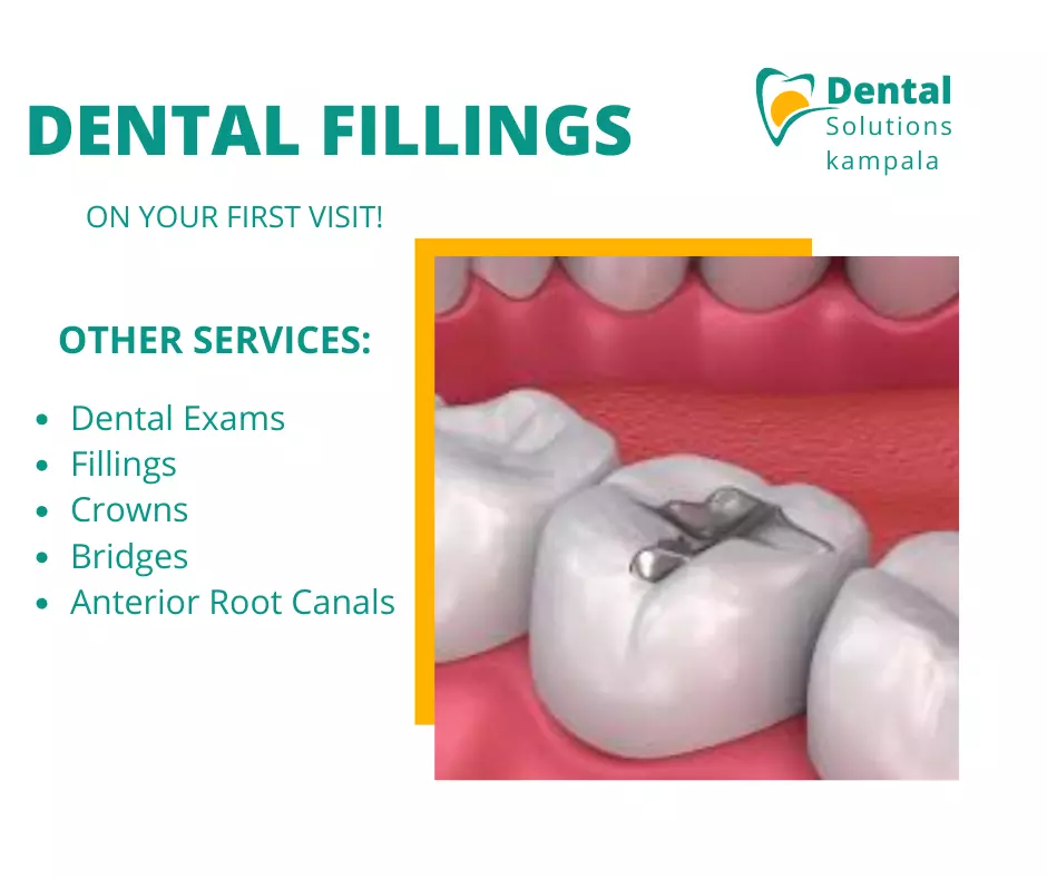 Dental Fillings in Kampala Dental Clinic in Kampala