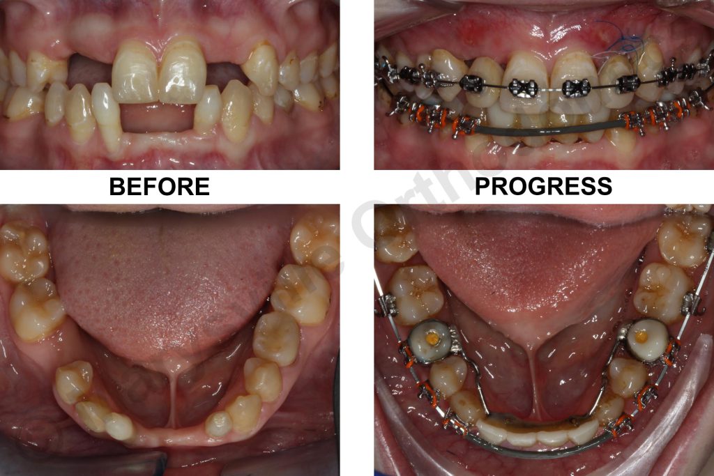 Can you get braces with missing teeth? Dental Clinic in Kampala