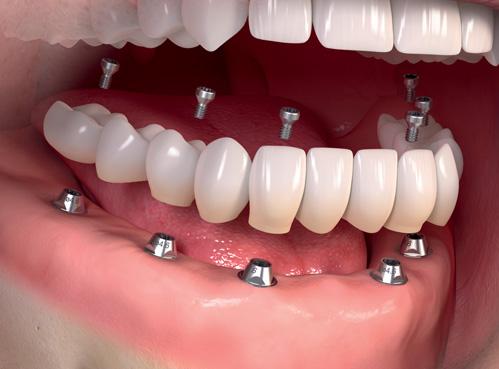 Tooth Jewelry - Tooth Gems in Kampala Uganda - Dental Clinic in Kampala