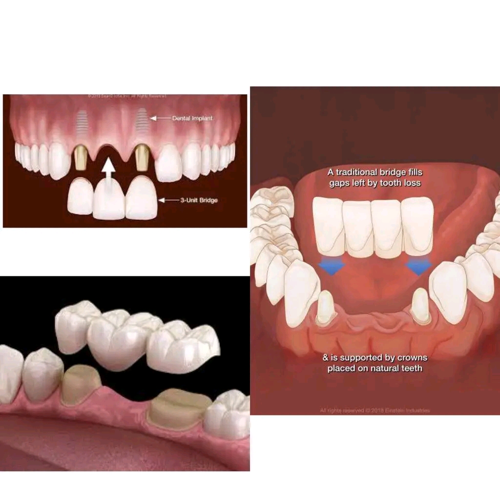 How much is teeth replacement in Uganda?