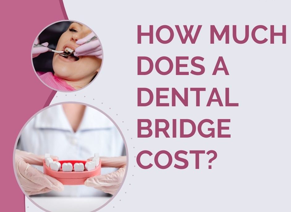 How Much Does a Dental Bridge Cost in Uganda?