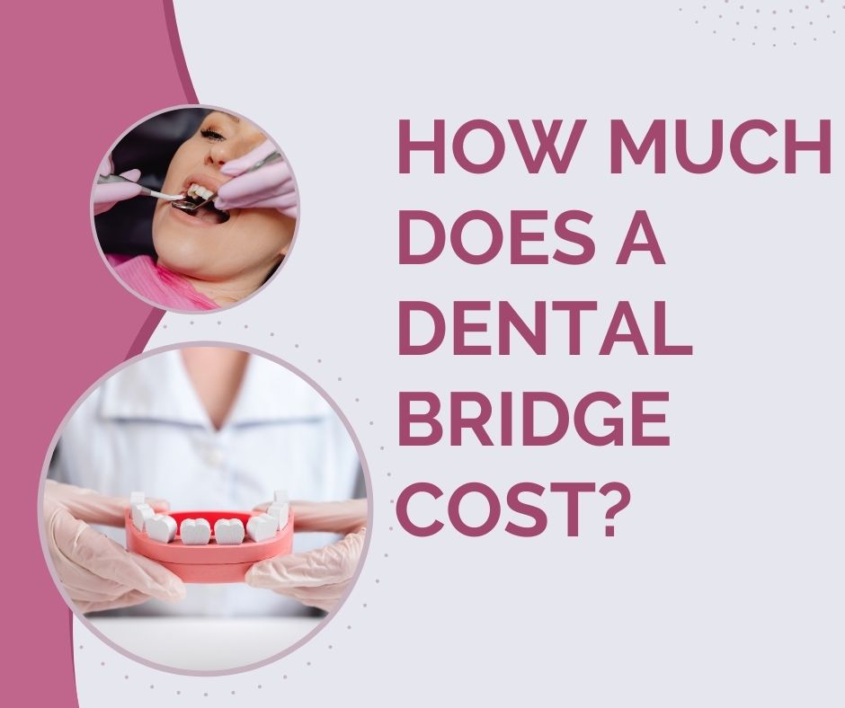 How Much Does a Dental Bridge Cost in Uganda? Dental Clinic in Kampala