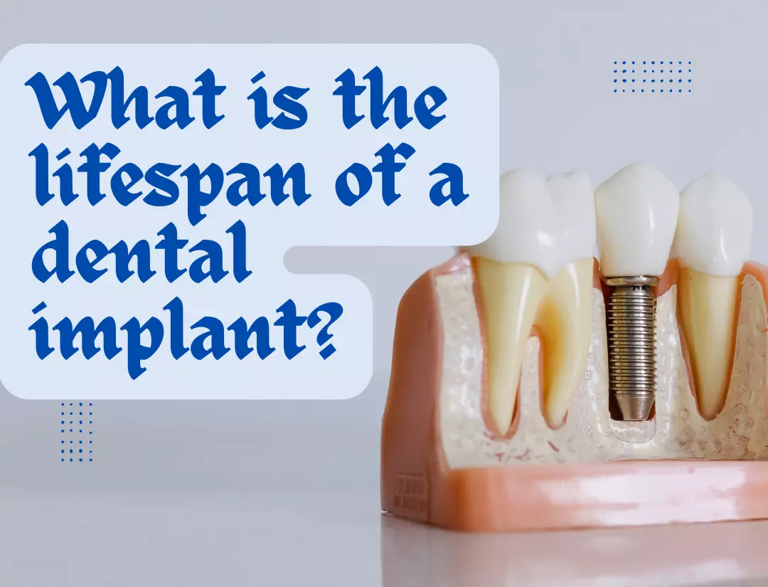 What is the lifespan of a dental implant? Dental Clinic in Kampala