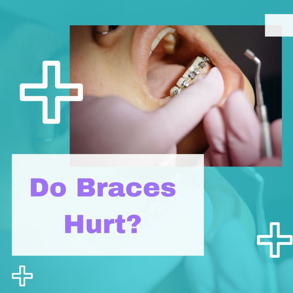 Do Spacers Hurt? Uncover the Truth About Comfort and Pain